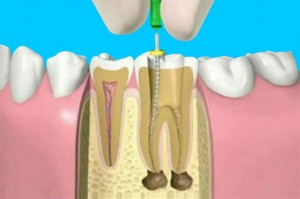 root-canal-01